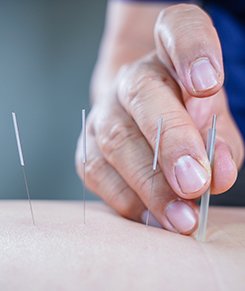 Acupuncture